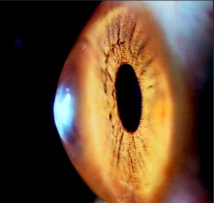 錐形角膜是因眼內壓力太大而導致角膜形成向外凸出的異常形態，它會造成視力急劇減弱、角膜水腫等問題。