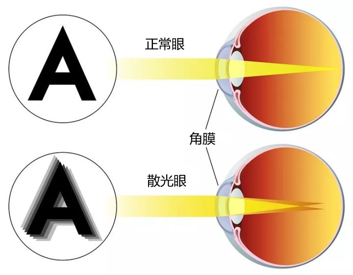 散光眼角膜不能令光線均勻進入眼球，反而形成多個焦點，從而造成視線模糊重影問題