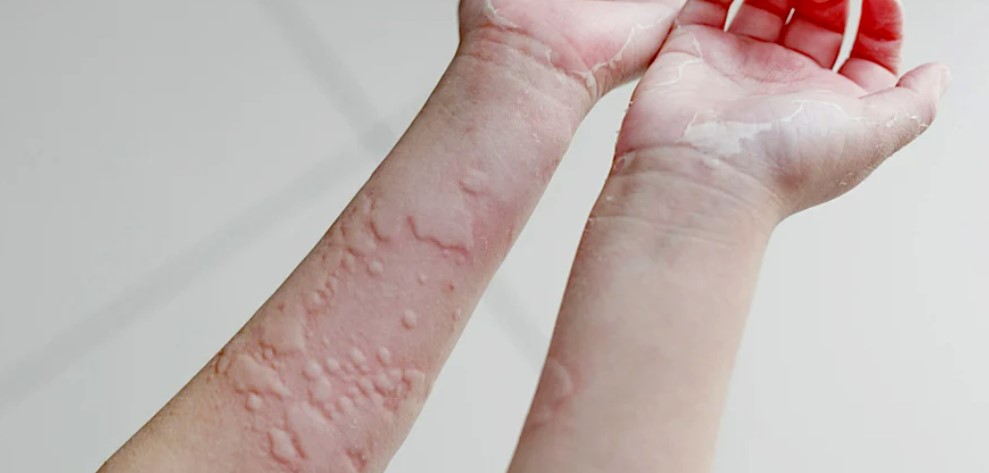 蕁麻疹最典型症狀是皮膚浮起成塊甚至成片的腫包